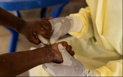  Saúde confirma primeiro caso de nova cepa de mpox no Brasil